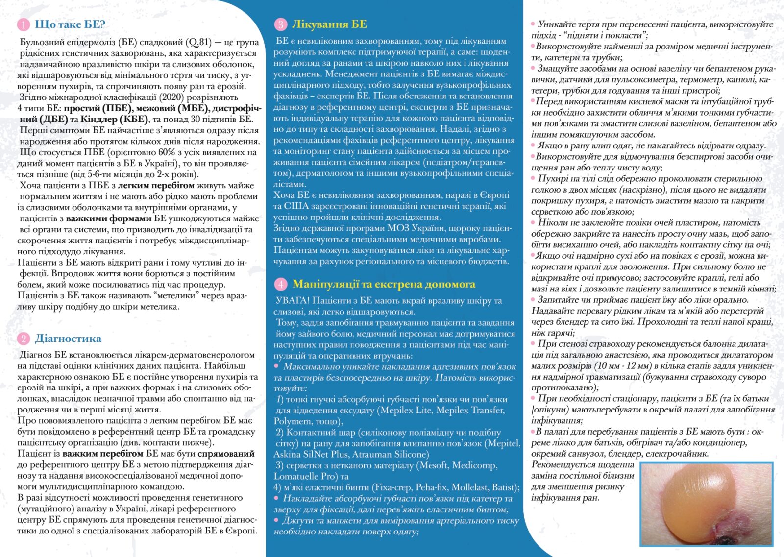 Бульозний епідермоліз